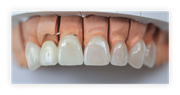 Die Zahnarztpraxis Dr. med. dent. Armin Eisermann in Blaustein bietet Ihren Patienten ein umfangreiches Leistungsangebot der Zahntherapie an.